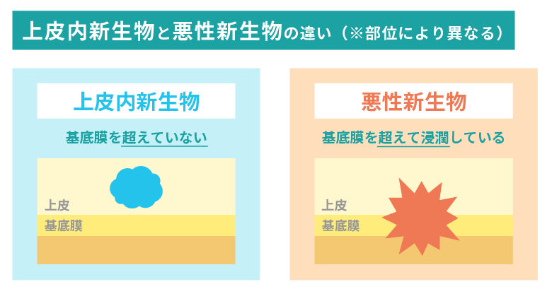 上皮内新生物と悪性新生物の違い
